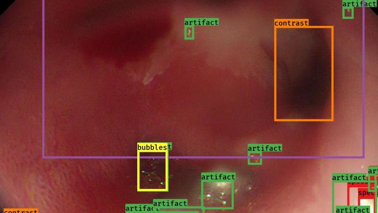 An image from an endoscopy video with detected artefacts highlighted with boxes coloured according to the type of artefact e.g. contrast (orange), bubbles (yellow).